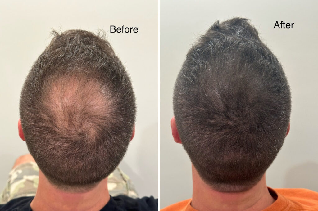 Scalp Micropigmentation Manchester